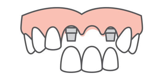 multiple tooth replacement