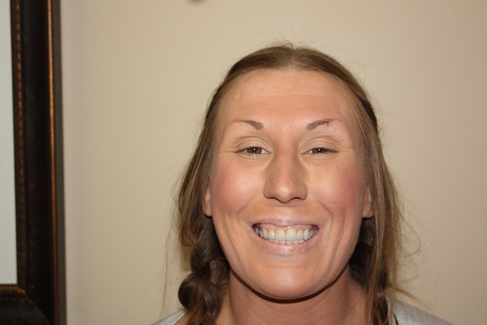 Lauren After Smile Dental Implants San Diego