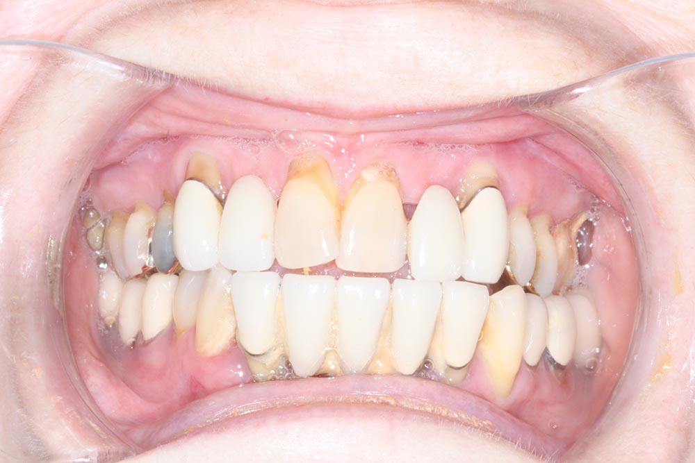 Before Dental Implants in San Diego Smile 4