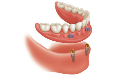 snap on smile San Diego